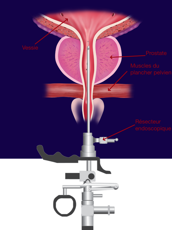 résection endoscopique prostate tratamentul prostatitei nouă metodă