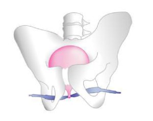 Figure 2. Mise en place d’une bandelette sous-urétrale TOT