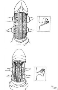 Figure 2. Technique de plicatures simples